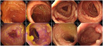 Adult pancreatoblastoma with atypical histological morphology combined with familial adenomatous polyposis: a rare case report